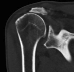 Shoulder Massive Rotator Cuff Tear CT